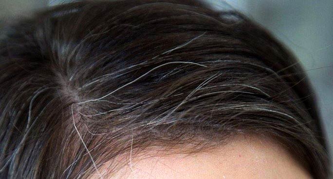 علت سفید شدن موی سر