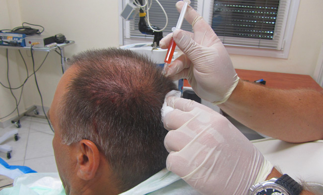 هزینه کاشت مو به روش سلولهای بنیادی