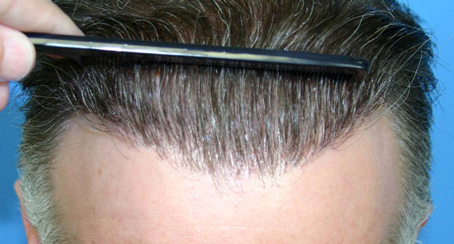کاشت مو | کاشت ابرو | پیوند موی طبیعی 